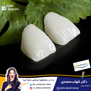 تفاوت لمینیت و روکش دندان چیست؟ - کلینیک دندانپزشکی دکتر شهاب محمدی